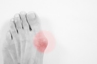 Treating a Bunion May Require Surgery