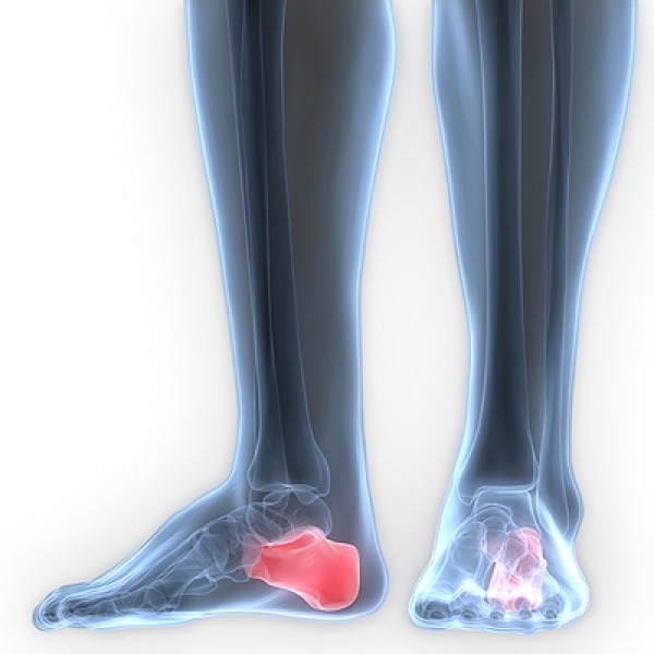 Heel Spurs of the Moment — Podiatry Group of Annapolis, P.A.