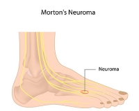 Where is the Pain From Morton’s Neuroma Located?