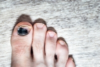 Causes and Treatment of Black Toenail