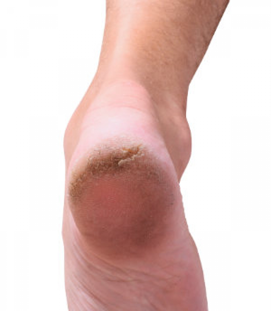 Dry, Cracked Feet: Causes and Remedies
