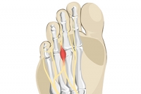 Why Does Morton’s Neuroma Develop?